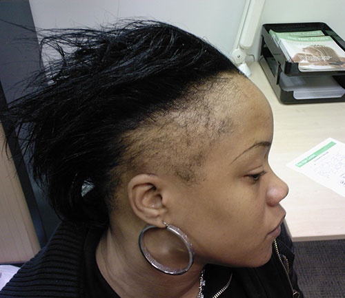 Tratament alopecie difuza femei